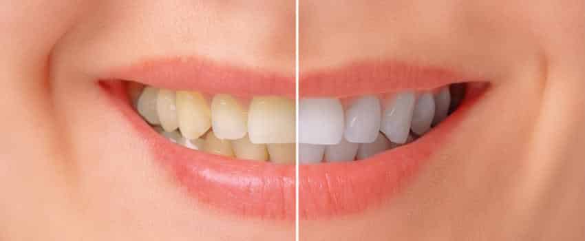 Teeth Whitening Dental Studio Belgrade Kolmident