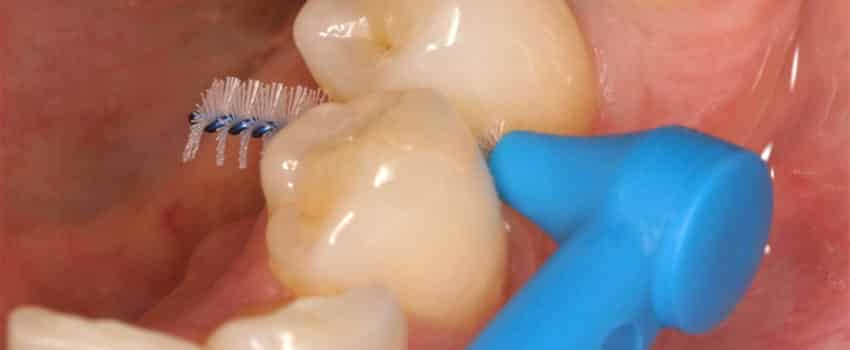 Parodontologija - Interdentalna cetkica